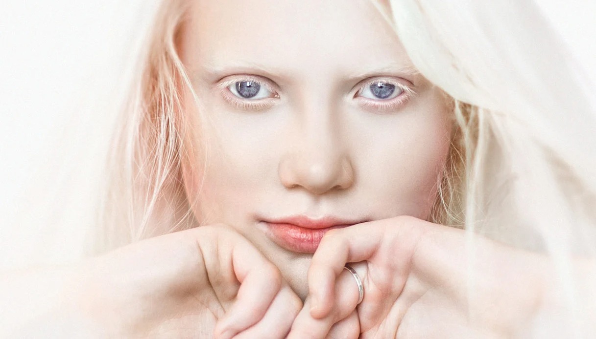 giornata internazionale albinismo