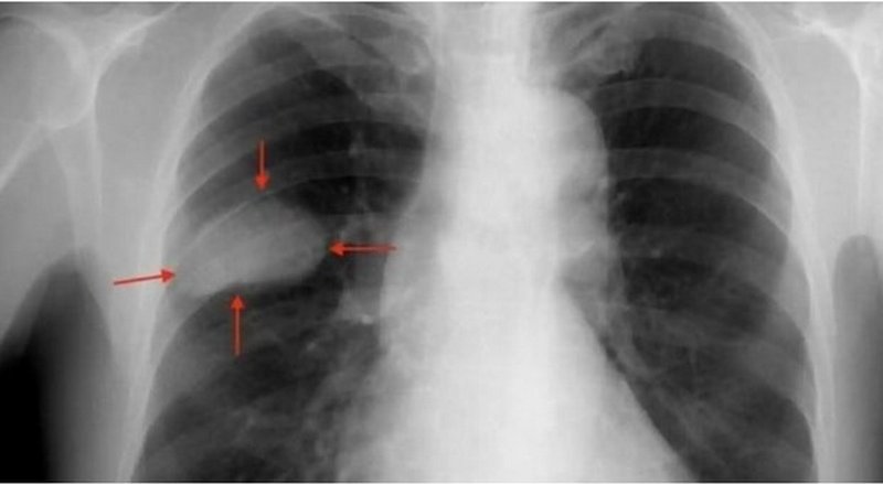 diagnosi sbagliata donna muore tumore polmoni mal di schiena spagna