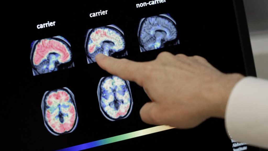 nuova forma di Alzheimer