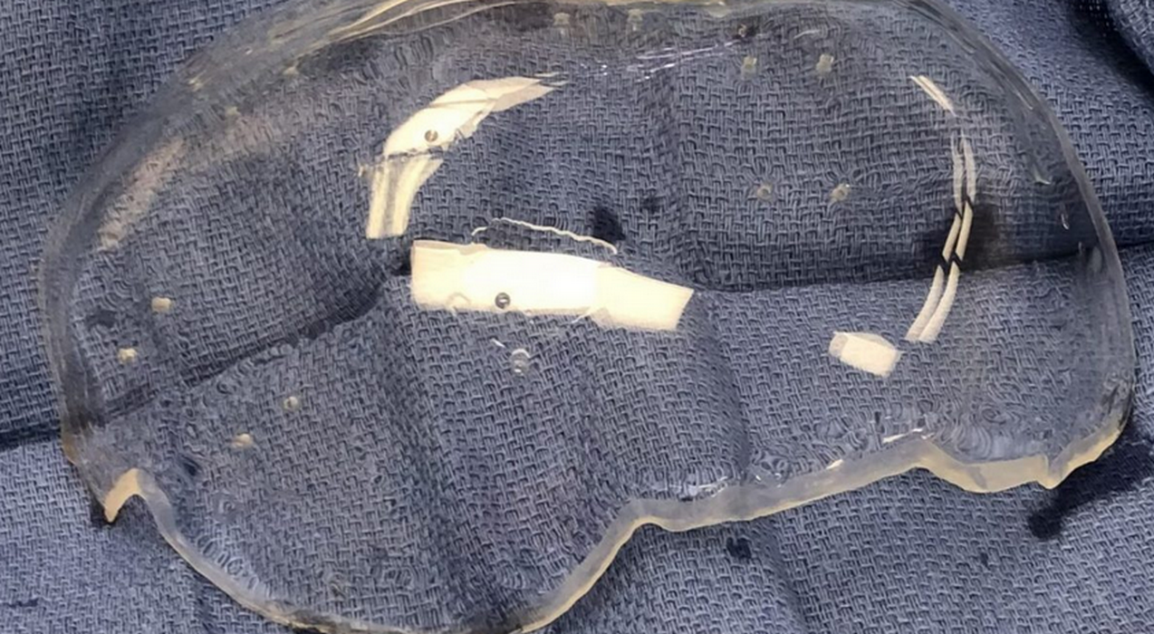 california impiantato primo cranio plastica trasparente prima volta mondo