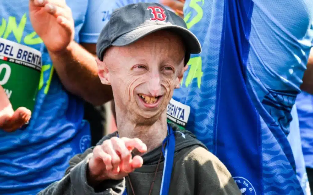 Sammy Basso morto cos'è progeria malattia