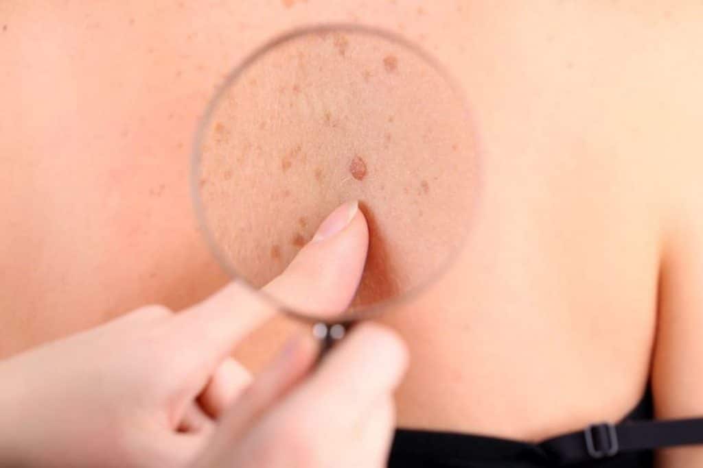 Melanoma metastatico cura Italia