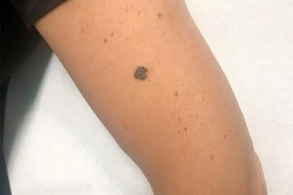 melanoma napoli primo paziente mix batteri